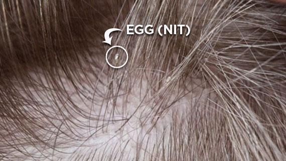 Lice Clinics Arizona